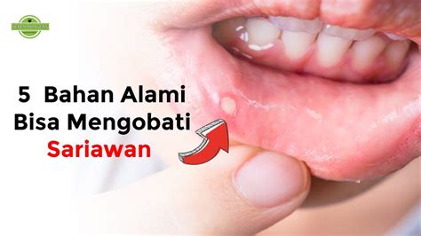 Inilah 5 Cara Mengobati Sariawan Dengan Bahan Alami Youtube