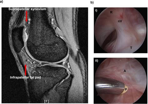 Fibrosis Is A Common Outcome Following Total Knee Arthroplasty