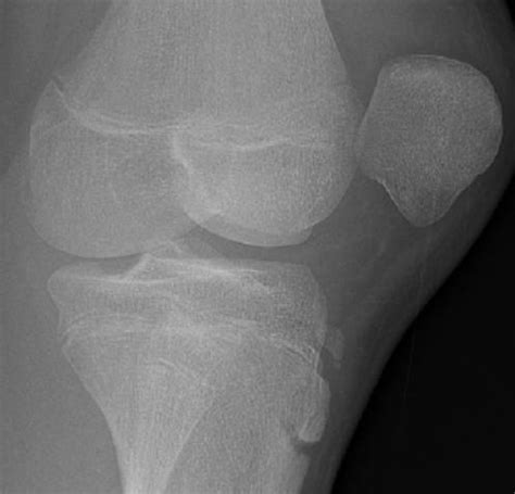 Patella kneecap dislocation, Patella kneecap pain | Dr.Raj Kanna