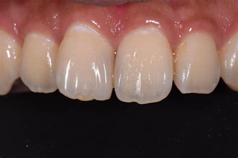 Kerr Harmonize Derotation of Tooth 11