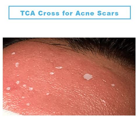 TCA Cross For Acne Scars In Birmingham Midland Skin