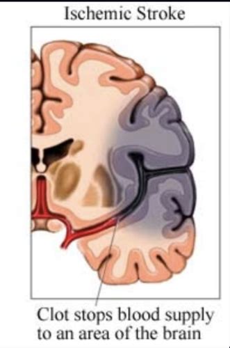 Stroke Flashcards Quizlet