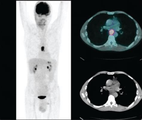 18F FDG PET CT Imaging In Oncology Annals Of Saudi Medicine