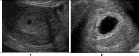 Figure 1 From A Logistic Model Of Early Pregnancy Ultrasound