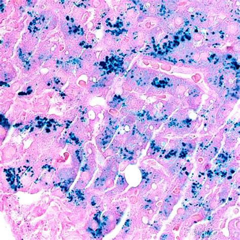 Hereditary Hemochromatosis | Basicmedical Key