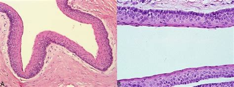 A The Connective Tissue Shows Mild Infiltration Of Inflammatory Cells