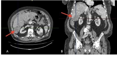 Primary Peritoneal High Grade Serous Carcinoma In A Man A Case Report