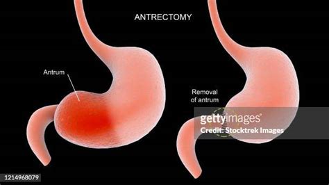 Vagotomy Photos and Premium High Res Pictures - Getty Images