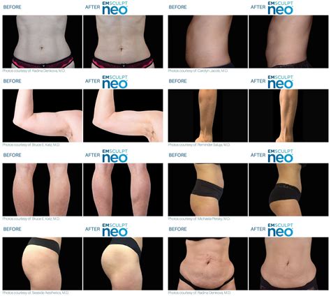 Emsculpt Neo Body Sculpting In Spotsylvania Vergina