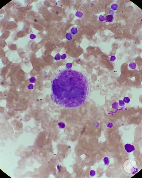 Itp Megakaryocyte Morphology 1