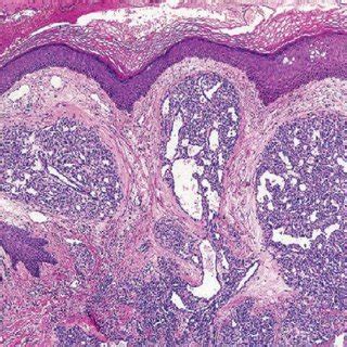 Showing Pyogenic Granuloma On The Lower Lip Courtesy Of Prof