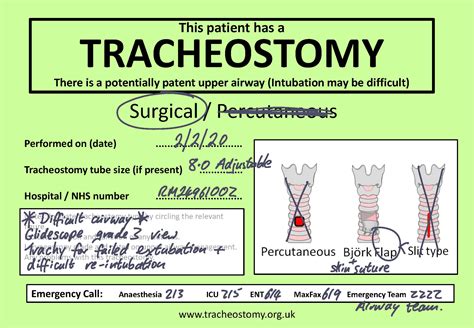 Tracheostomy