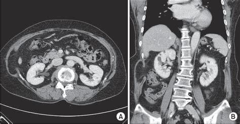 Pdf A Rare Nonincisional Lateral Abdominal Wall Hernia Hot Sex Picture