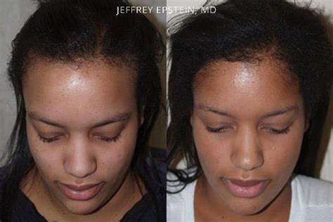 Forehead Reduction Surgery Photos Miami Fl Patient