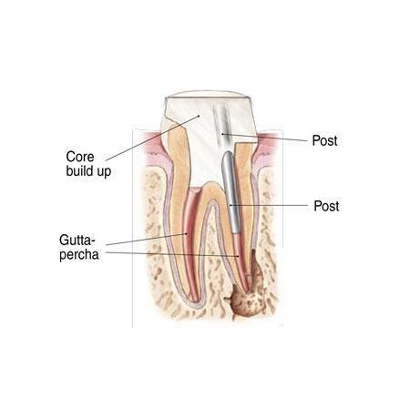 's Treatment Photos | Post and Core Build-up