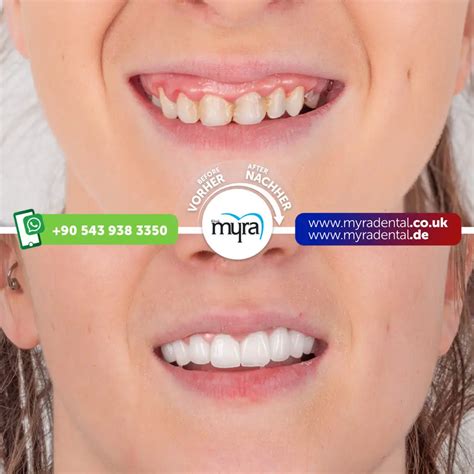 How To Get Your Teeth Done In Turkey Myra Dental Center Turkey