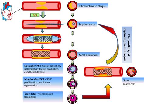 Understanding The Role Of Non Coding RNA NcRNA In Stent Restenosis