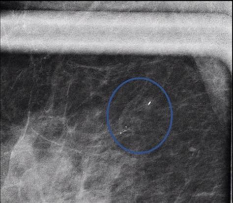 Magnification Image Of The Group 1 Calcifications In The Upper Outer