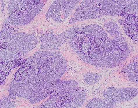 Sebaceous Carcinoma Histology