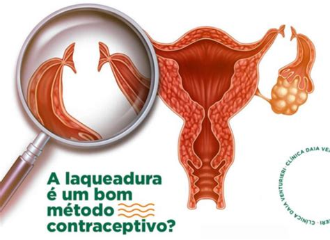 O Que É Laqueadura Na Mulher - » A laqueadura é um bom método contraceptivo?
