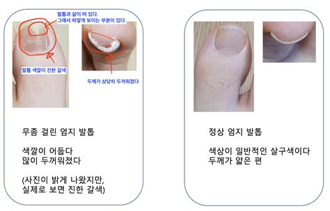 바르는 발톱무좀약 6개월 후기 무조날s 바르지오