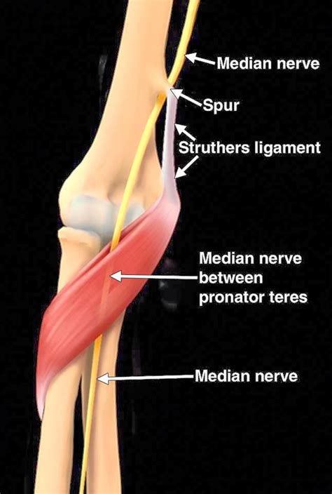 ANATOMY SMS: Struthers ligament