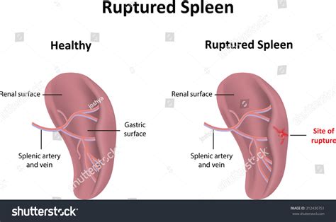 Ruptured Spleen Stock Photo 312430751 : Shutterstock