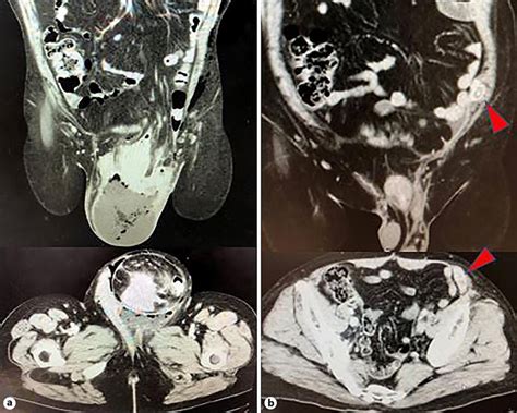 Figure 1 From Laparoscopic Resection Of An Abdominal Wall Metastasis 5