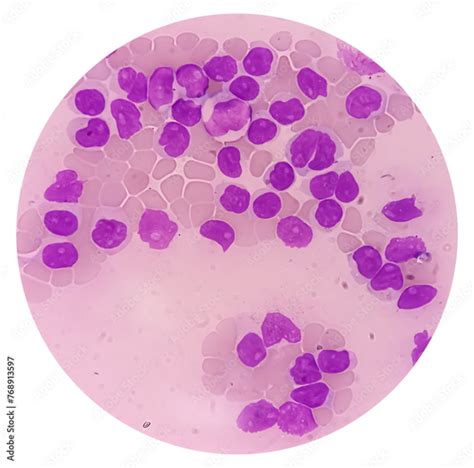 Lymphocytosis with Thrombocytopenia. Smear show white blood cells, red ...