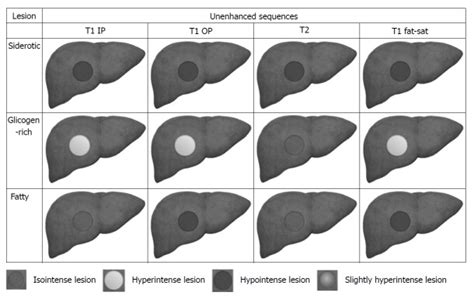 Mr With Gd Eob Dtpa In Assessment Of Liver Nodules In Cirrhotic Patients Abstract Europe Pmc