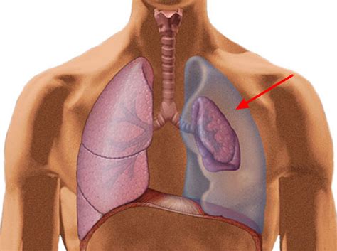 Pneumothorax Causes Signs Symptoms Treatment