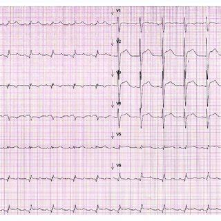 Electrocardiogram Showing Normal Sinus Rhythm With HR Of 83 Bpm