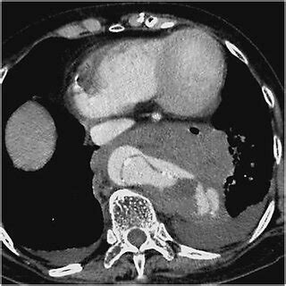 A Year Old Man With Stanford Type A Ulp Type Aortic Dissection