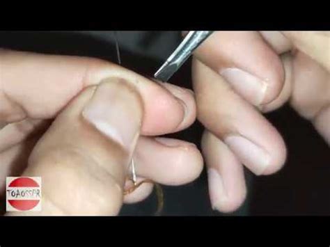 How To Remove A Hair Splinter From Foot - HOWTOERMOV