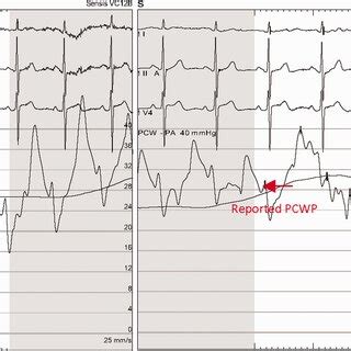 Example of reported pulmonary capillary wedge pressure (28 mmHg),... | Download Scientific Diagram