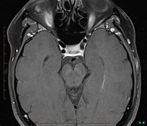 Giant Cell Arteritis Image