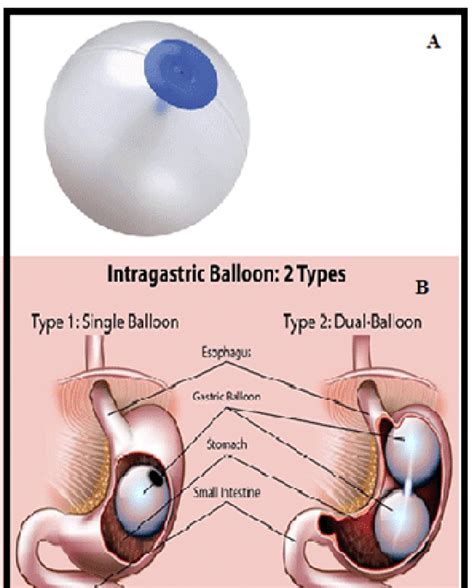 A B Types Of Intra Gastric Balloon Single And Dual Balloon