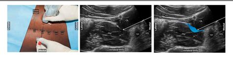 Figure 2 From Outcome Of Ultrasound Guided Anterior Quadratus Lumborum