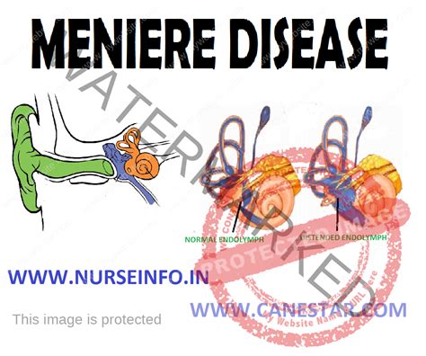 Menieres Disease Nurse Info