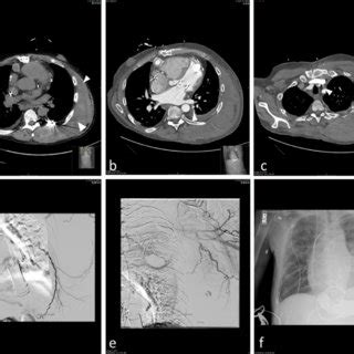 Year Old Male Patient With Lvad Due To Dilated Cardiomyopathy