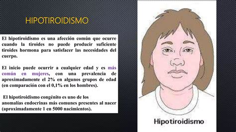 Hipertiroidismo Hipotiroidismo Ppt