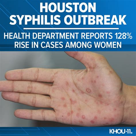 Khou News Houston On Twitter The Health Department Said Congenital