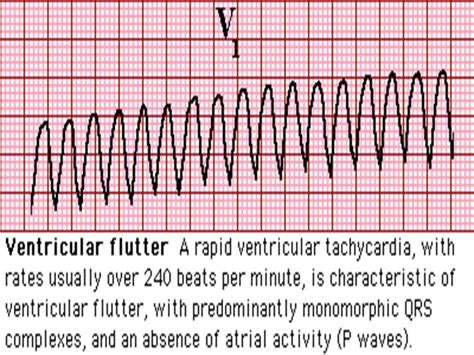 Pin On Ventricular Flutter