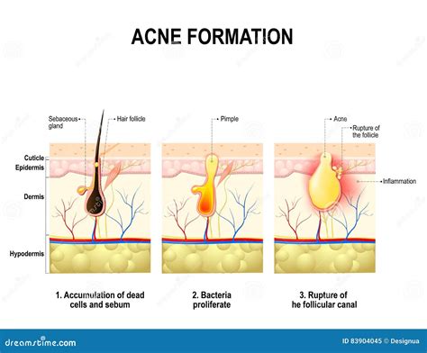 Acne Formation Human Skin Cartoon Vector 83904045