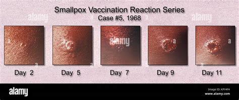 Progression Of The Appearance Of A Smallpox Vaccination Site