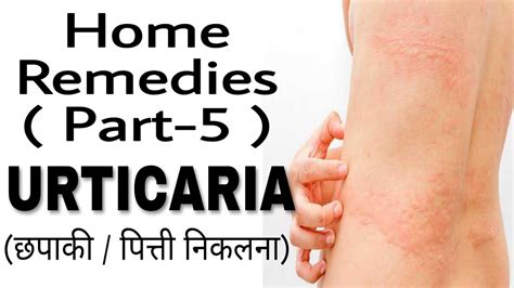 Urticaria यानि कि छपाकी की Home Remedies Youtube