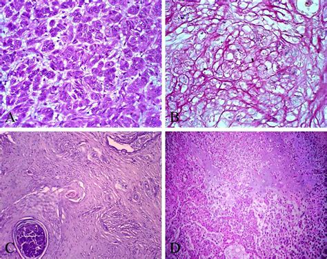 (A) Mucinous carcinoma. H&E. 40x. (B) Mucinous carcinoma. PAS. 40x. (C ...