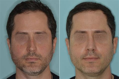 Fixing A Crooked Nose With Rhinoplasty Miami Fl