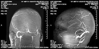 Dr Balaji Anvekar FRCR Hyperdense Sinus On CT Brain