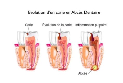 Abcès Dentaire Cabinet Dentaire du Dr Julien Bucci